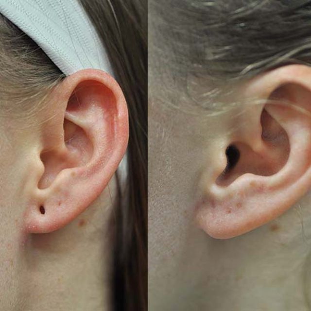 Earlobe Repair